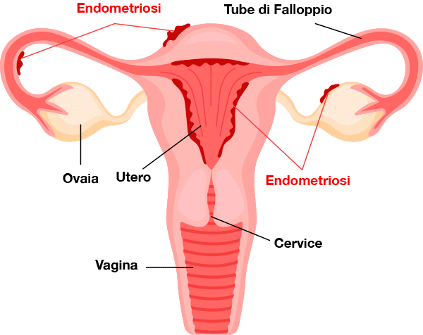 endometriosi